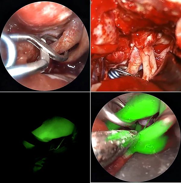 突破颅底禁区︱滨医附院神经外科成功完成高难度颅底动脉瘤开颅夹闭术